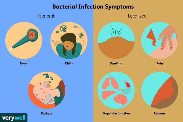Cum să alegi antibioticul potrivit pentru o infecție bacteriană?